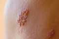 Bildunterschrift: Gürtelrose geht oft mit starken Schmerzen und dem typischen einseitigen Hautausschlag einher. Foto: Shingles Cluster/stock.adobe.com/akz-o