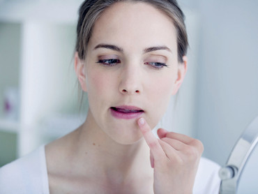 Lippenherpes: Warum es brennt, und was hilft