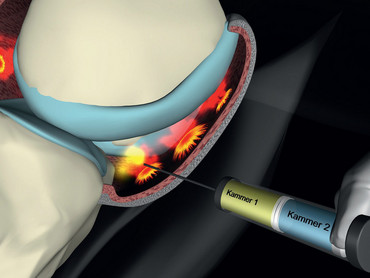 Innovative Therapie bei Arthrose